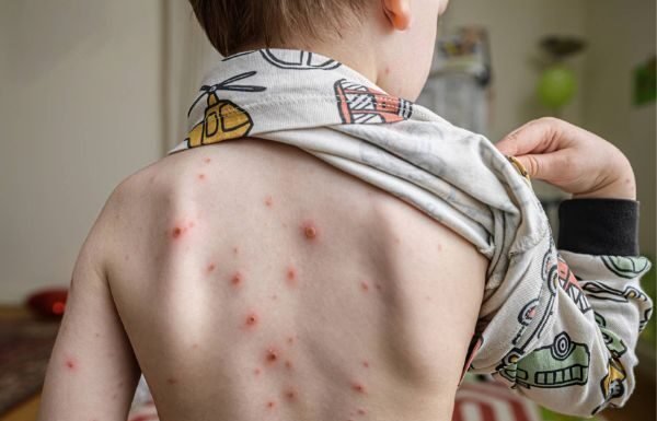 Aumento do número de casos de catapora preocupa comunidade médica baiana